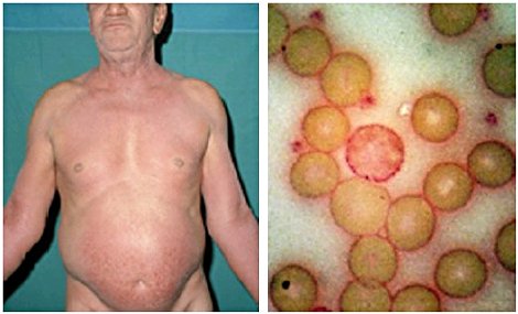 Sézary-Syndrom, Fotos: Herbert L. Fred, MD and Hendrik A. van Dijk | CC Namensnennung 2.0