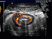 Ultraschallbild: M. Crohn mit Wandverdickung und verstärkter Durchblutung einer Dünndarmschlinge
