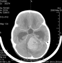 Medulloblastom im Schädel-CT nach Kontrastmittelgabe bei einem sechsjährigen Mädchen.