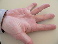 Morbus Dupuytren am Ringfinger der rechten Hand. Foto: Frank C. Müller. Quele: Wikipedia
