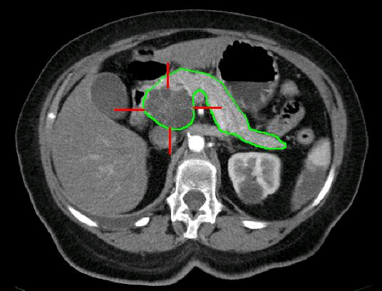 Zystisches Adenokarzinom des Pankreas im CT, Urheber: MBq