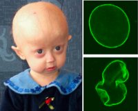 Progeria. Quelle: Wikimedia commons. CC BY 2.5