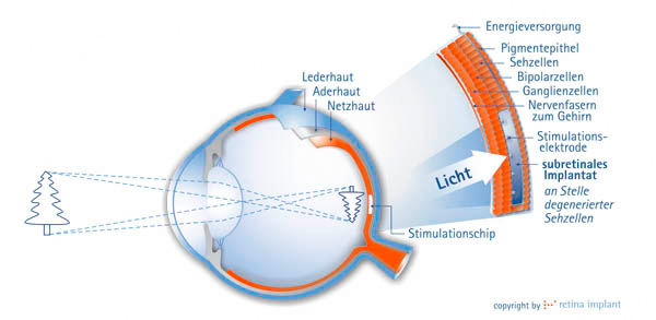 Retina-Implantat - Diagramm vom Chip